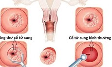 Phát hiện sớm ung thư cổ tử cung