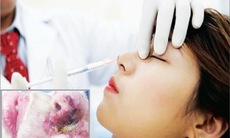 Tiêm filler để làm đẹp, phải nhập viện khẩn cấp