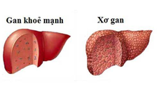 Bệnh xơ gan cần kiêng gì?