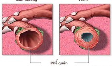 Phòng biến chứng viêm phế quản cấp