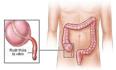 Viêm ruột thừa, vì sao cần phẫu thuật ngay?