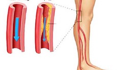 Nhận biết bệnh động mạch chi dưới mạn tính