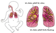 Không chủ quan với biến chứng sau sởi