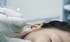 Xử trí dị vật trong tai