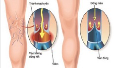 Bài thuốc trị viêm tắc tĩnh mạch chi