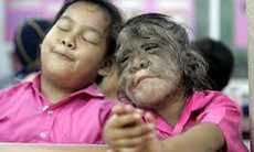 Biến thành “người sói” vì uống thuốc dán sai nhãn