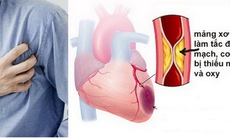 Xơ vữa động mạch - diễn biến âm thầm và nguy hiểm