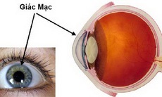 Viêm loét giác mạc, tránh thế nào?