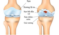 Cách kiểm soát đau khớp khi “trái gió trở trời”