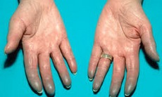 Thuốc điều trị hội chứng Raynaud