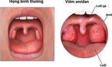 Bài thuốc trị viêm amidan