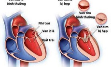 Bệnh van tim có nguy hiểm không?