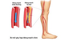Phát hiện sớm tắc động mạch nuôi chi cấp tính