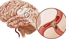 Lưu ý khi dùng một số thuốc trị thiểu năng tuần hoàn não