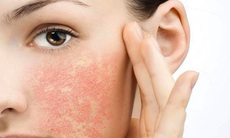 Chăm sóc và chữa trị da bị dị ứng mỹ phẩm