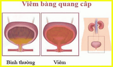 Viêm bàng quang cấp: Để lâu dễ gây suy thận