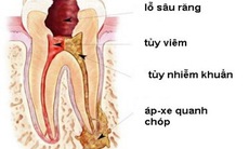 Phòng viêm nhiễm hàm mặt