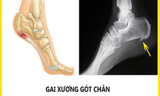 Thường xuyên đau gót chân, bệnh gì?