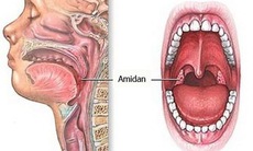 Đừng để viêm amidan trở thành áp-xe