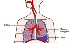 Biến chứng nguy hiểm của bệnh lao phổi