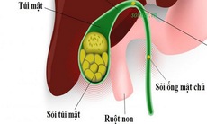 Cách phòng tránh sỏi mật hiệu quả