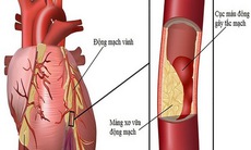 Không chủ quan với cơn đau thắt ngực ổn định