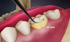 Bệnh nha chu có nguy hiểm?