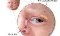Chảy nước mắt sống là bệnh gì?