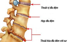 Nhận biết một số bệnh cột sống thường gặp