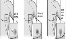 Đàn ông cũng phải cảnh giác với ung thư vú
