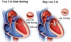 Nhận biết và phòng ngừa hẹp van hai lá