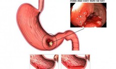 Xử trí khi bị xuất huyết dạ dày