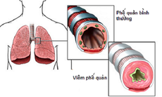 Mật ong trong bài thuốc trị viêm phế quản