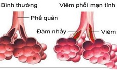 Phòng bệnh viêm phổi ở người lớn