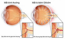 Thiên đầu thống: Phát hiện sớm, ngừa biến chứng nguy hiểm