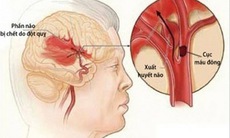 Nắng nóng gay gắt kéo dài, đề phòng đột quỵ