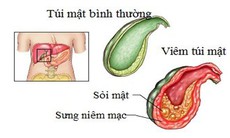 Viêm túi mật và những nguy biến