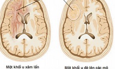 Dấu hiệu cảnh báo u não