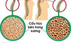 Cách phát hiện và ngừa loãng xương