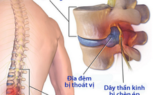 Thoát vị đĩa đệm: khi nào nên mổ?