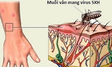 Điều cần biết về sốt xuất huyết và biến chứng của bệnh