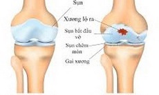 Cách “sống chung” với thoái hóa khớp