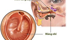 Chăm sóc trẻ bị viêm tai giữa