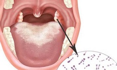 Những điều cần lưu ý khi dùng thuốc trị bạch hầu