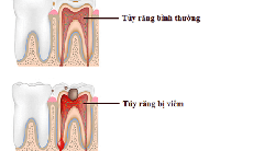 Viêm tủy răng do đâu?