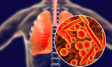 Lao phổi: phải tuân thủ điều trị mới khỏi bệnh