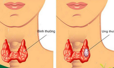 Ung thư tuyến giáp có thể chữa khỏi nếu phát hiện sớm, chữa trị đúng