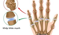 Đề phòng viêm thoái hoá khớp ngón tay