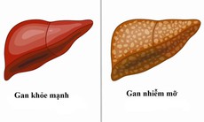 Phòng bệnh gan nhiễm mỡ