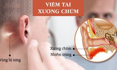 Cảnh giác với viêm tai xương chũm